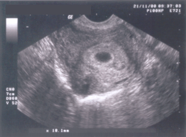Ultraschallbild der 6. Schwangerschaftswoche