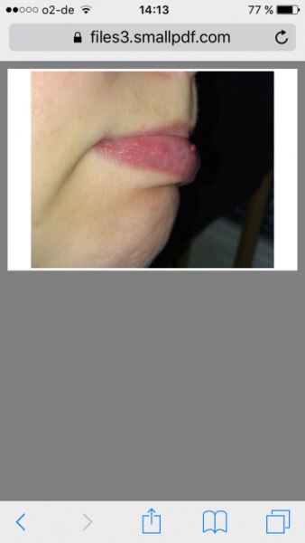 Bild zu Was ist das an meiner Lippe? - Frauengesundheit