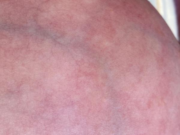 Bild zu Lila Adern auf Brüsten - Frauengesundheit