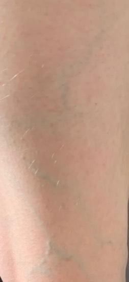 Bild zu Stark sichtbare Venen Beinrückseite - Frauengesundheit