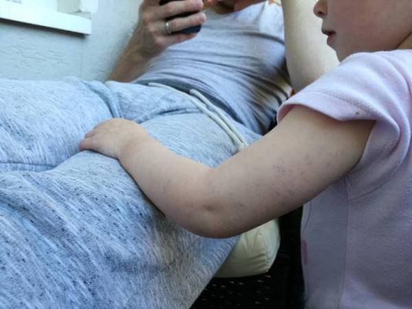 Bild zu Besenreiser am Arm seit Geburt - Rund ums Kleinkind - Tipps für Eltern