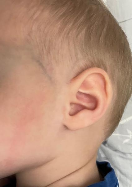 Bild zu Roter strich im gesicht - Rund ums Kleinkind - Tipps für Eltern