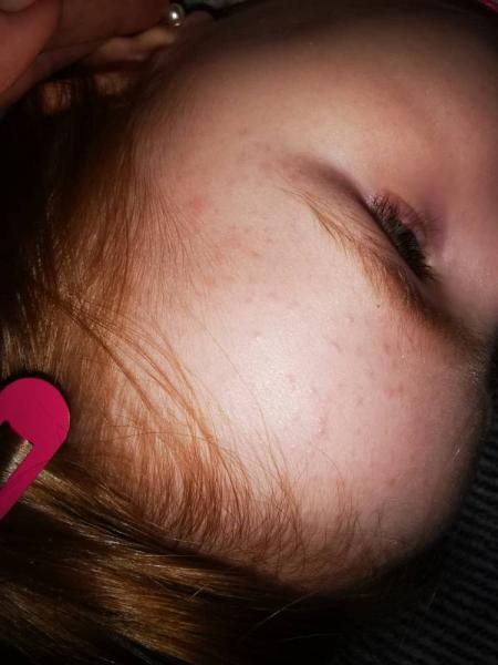 Bild zu Pickelchen an der Stirn 🙁🙁 - Rund ums Kleinkind - Tipps für Eltern