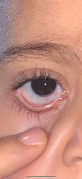 Bild zu Auge sieht komisch aus - Rund ums Kleinkind - Tipps für Eltern
