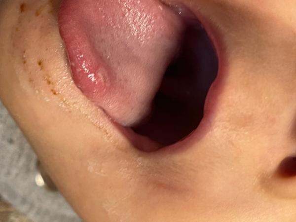 Bild zu Aphte oder doch was anderes? - Rund ums Kleinkind - Tipps für Eltern