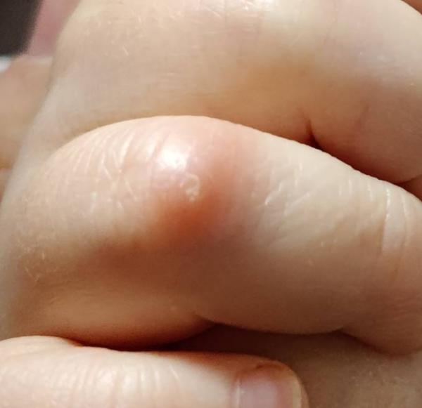 Bild zu Warze am Finger? (16 Monate) - Rund ums Kleinkind - Tipps für Eltern