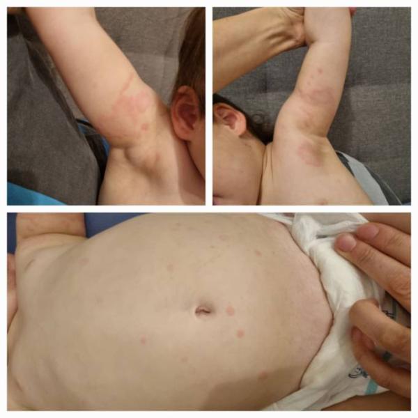 Bild zu Ringelröteln??? - Rund ums Kleinkind - Tipps für Eltern