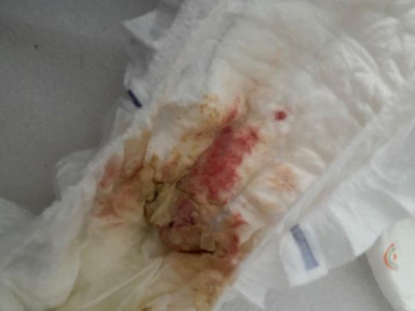 Bild zu Blut im Stuhlgang - Rund ums Kleinkind - Tipps für Eltern
