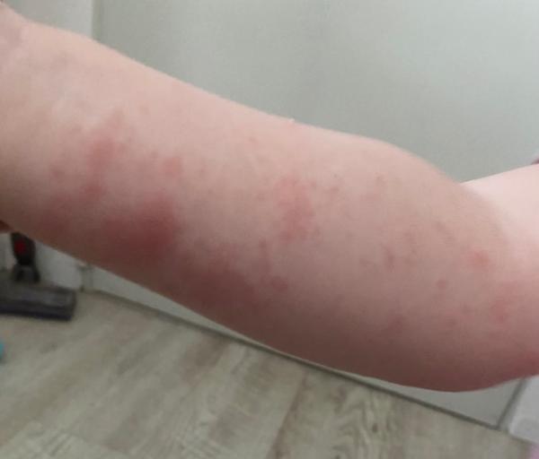 Bild zu Hitzepickel/Sonnenallergie - Rund ums Kleinkind - Tipps für Eltern