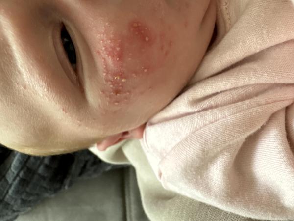 Bild zu Babyakne - Rund ums Kleinkind - Tipps für Eltern
