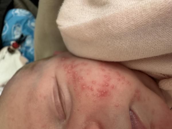 Bild zu Babyakne - Rund ums Kleinkind - Tipps für Eltern