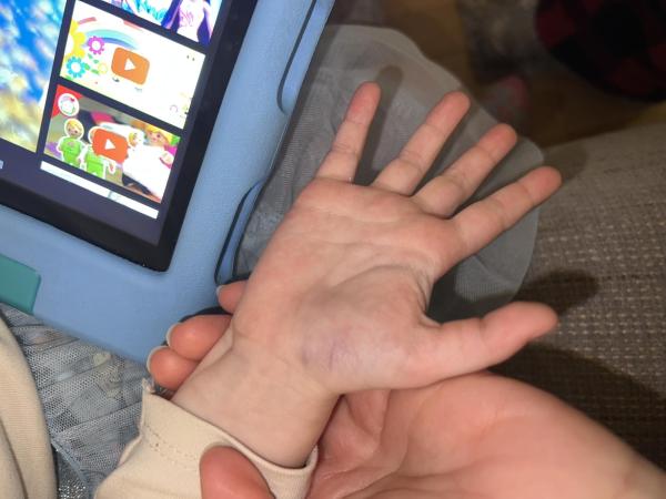 Bild zu Blaue Flecken an der Hand? - Rund ums Kleinkind - Tipps für Eltern