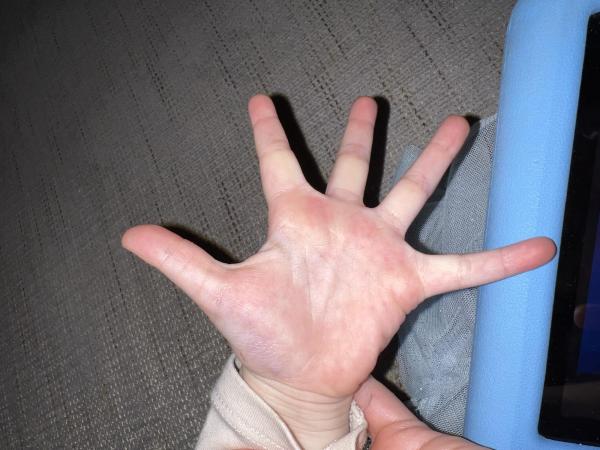 Bild zu Blaue Flecken an der Hand? - Rund ums Kleinkind - Tipps für Eltern