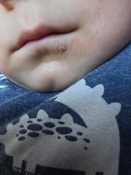 Bild zu Hand Mund Fuß oder Herpes ? - Rund ums Kleinkind - Tipps für Eltern