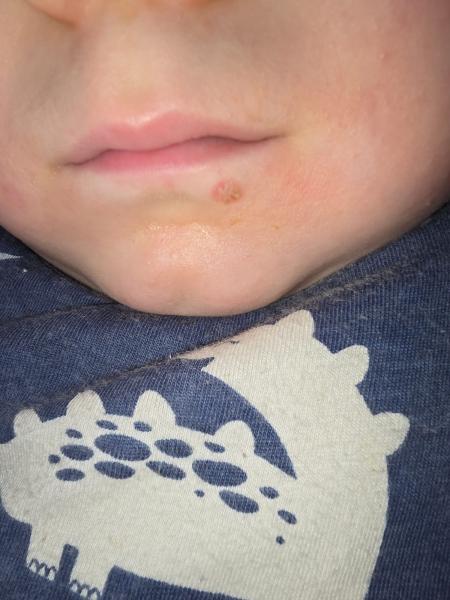 Bild zu Hand Mund Fuß oder Herpes ? - Rund ums Kleinkind - Tipps für Eltern