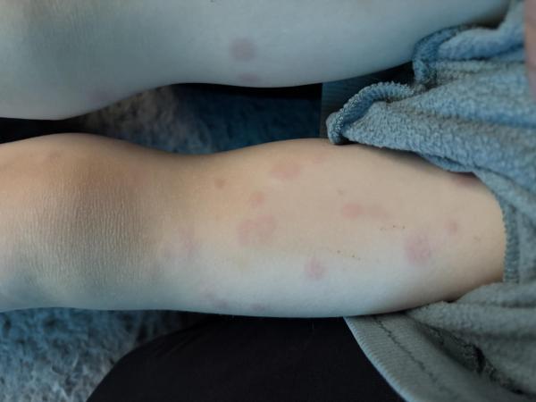 Bild zu Erythema multiforme? Kennt das jemand Hautausschlag - Rund ums Kleinkind - Tipps für Eltern