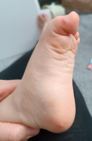 Bild zu Ist das Hand Fuß Mund? - Rund ums Kleinkind - Tipps für Eltern
