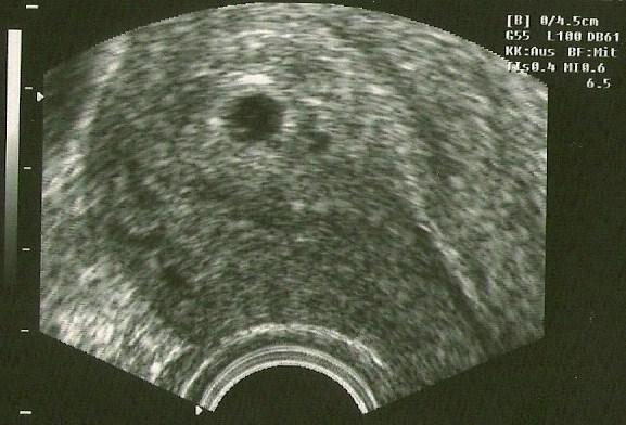 Bild zu Ich war gestern nochmal beim Frauenarzt, außerplanmäßig, uuuund - Schwanger - wer noch? Rund um die Schwangerschaft