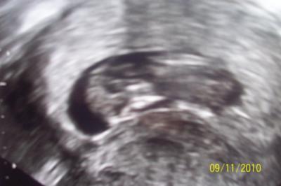 Bild zu Angst um mein Baby 12.SSW - Schwanger - wer noch? Rund um die Schwangerschaft