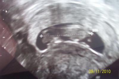 Bild zu Kopfform Baby :-( - Schwanger - wer noch? Rund um die Schwangerschaft