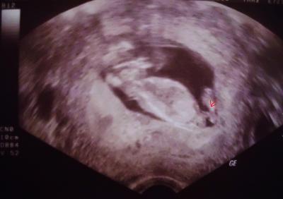 Bild zu Mädchen oder Junge - Schwanger - wer noch? Rund um die Schwangerschaft