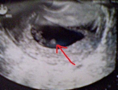 Bild zu Frage zu Ultraschallbild!! Anschauen! - Schwanger - wer noch? Rund um die Schwangerschaft
