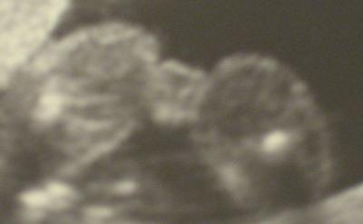 Bild zu Ultraschallbild 19 ssw - Schwanger - wer noch? Rund um die Schwangerschaft