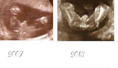 Bild zu Ultraschall-Foto - Hilfe bei Geschlecht! -NACHTRAG - Schwanger - wer noch? Rund um die Schwangerschaft