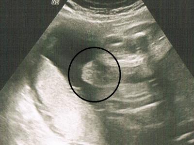 Bild zu Mädchen oder Junge??? Was seht ihr auf dem Ultraschallbild? - Schwanger - wer noch? Rund um die Schwangerschaft