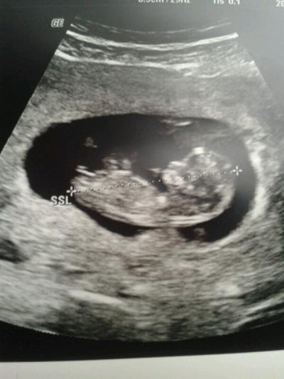 Bild zu Sieht man in diesem Profil etwas vom Geschlecht? - Schwanger - wer noch? Rund um die Schwangerschaft