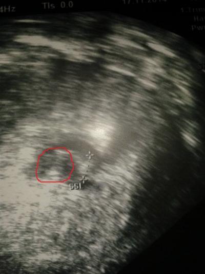 Bild zu Wucherung in der Fruchthöhle? - Schwanger - wer noch? Rund um die Schwangerschaft