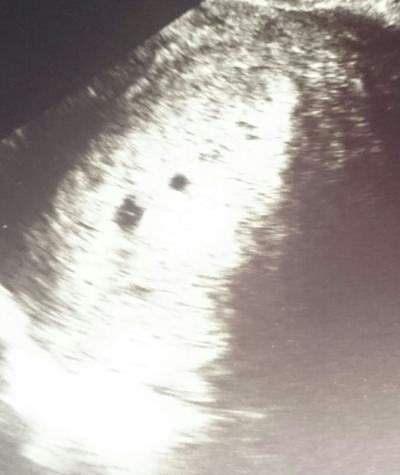 Bild zu Frage zu UltraschallBild - Schwanger - wer noch? Rund um die Schwangerschaft