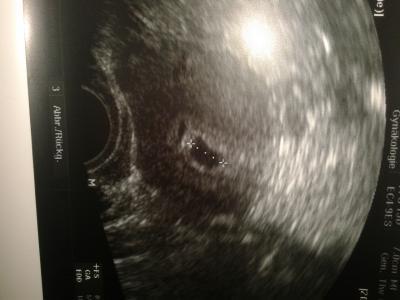 Bild zu darf ich euch mein us bild zeigen. . - Schwanger - wer noch? Rund um die Schwangerschaft