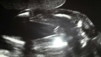 Bild zu Geschlecht erkennen - Schwanger - wer noch? Rund um die Schwangerschaft