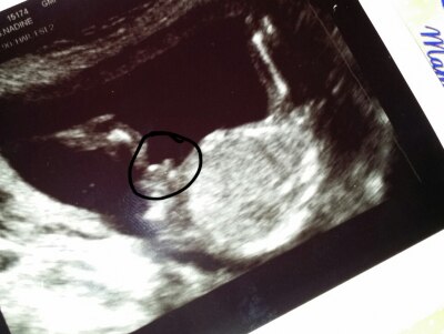 Bild zu 17. Woche outing...wie sicher ? - Schwanger - wer noch? Rund um die Schwangerschaft