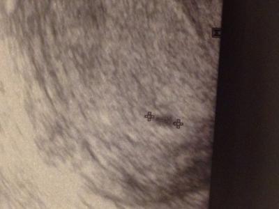 Bild zu Wann sah man bei euch ne fruchthöle/ fruchtsack ?!? - Schwanger - wer noch? Rund um die Schwangerschaft