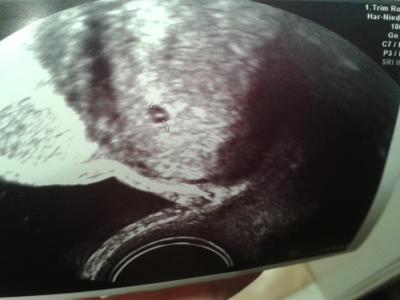 Bild zu Ultraschall 5./6.woche - Schwanger - wer noch? Rund um die Schwangerschaft