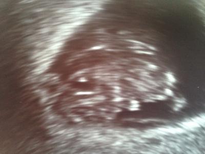 Bild zu Unsicher! - Schwanger - wer noch? Rund um die Schwangerschaft