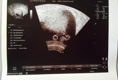 Bild zu Angst! 7+6 - Sehr unförmige Fruchthöhle & zu kleiner Embryo? - Schwanger - wer noch? Rund um die Schwangerschaft