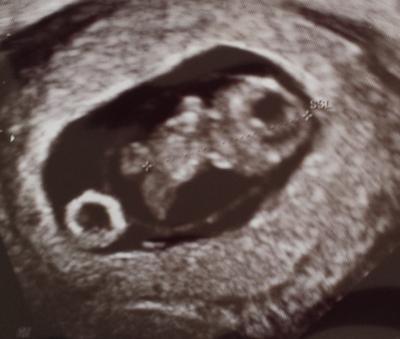 Bild zu Deutung des Ultraschallbildes - Schwanger - wer noch? Rund um die Schwangerschaft