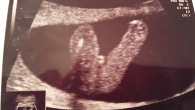 Bild zu Junge oder Mädchen was meint ihr? - Schwanger - wer noch? Rund um die Schwangerschaft