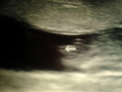 Bild zu guckt mal..seht ihr junge oder Mädchen - Schwanger - wer noch? Rund um die Schwangerschaft