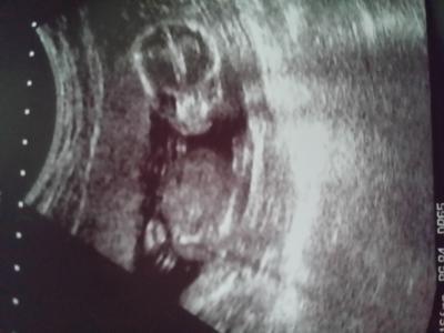 Bild zu Hilfe!!! könnt ihr auf dem Bild was erkennen? ?? - Schwanger - wer noch? Rund um die Schwangerschaft