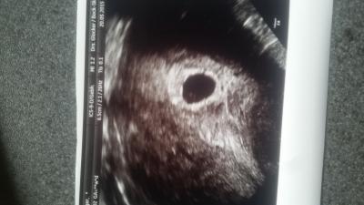 Bild zu 6+1 kein Herzschlag.... - Schwanger - wer noch? Rund um die Schwangerschaft