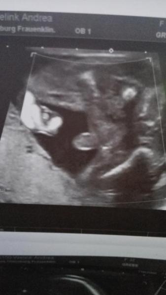 Bild zu Feindiagnostik Outing :-) OMG - Schwanger - wer noch? Rund um die Schwangerschaft