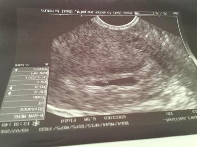 Bild zu Ssw 5+5 nur fruchthöle und Mini pununk - Schwanger - wer noch? Rund um die Schwangerschaft