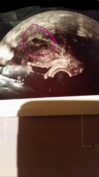 Bild zu Brauche dringend ein Rat - Schwanger - wer noch? Rund um die Schwangerschaft