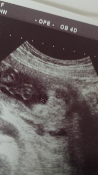 Bild zu Junge oder Mädchen, was sagt ihr? - Schwanger - wer noch? Rund um die Schwangerschaft