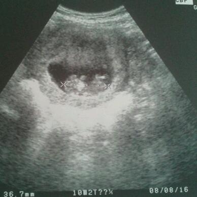 Bild zu Gestern Frauenarzt Termin gehabt - Schwanger - wer noch? Rund um die Schwangerschaft