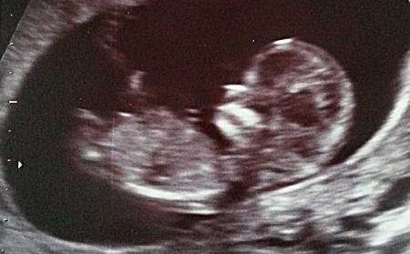 Bild zu Sieht man hier die Nackenfalte? - Schwanger - wer noch? Rund um die Schwangerschaft